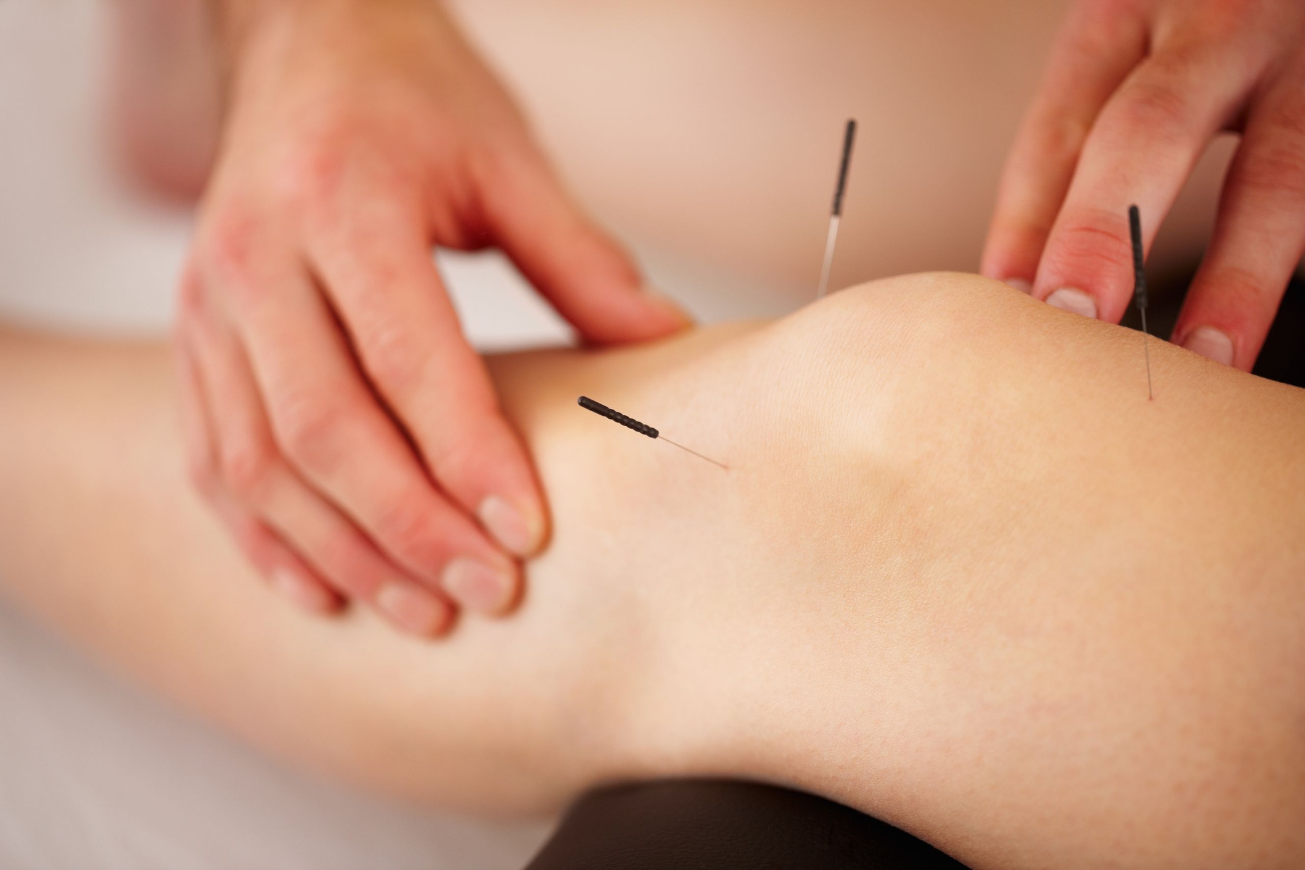 acupuncture 1