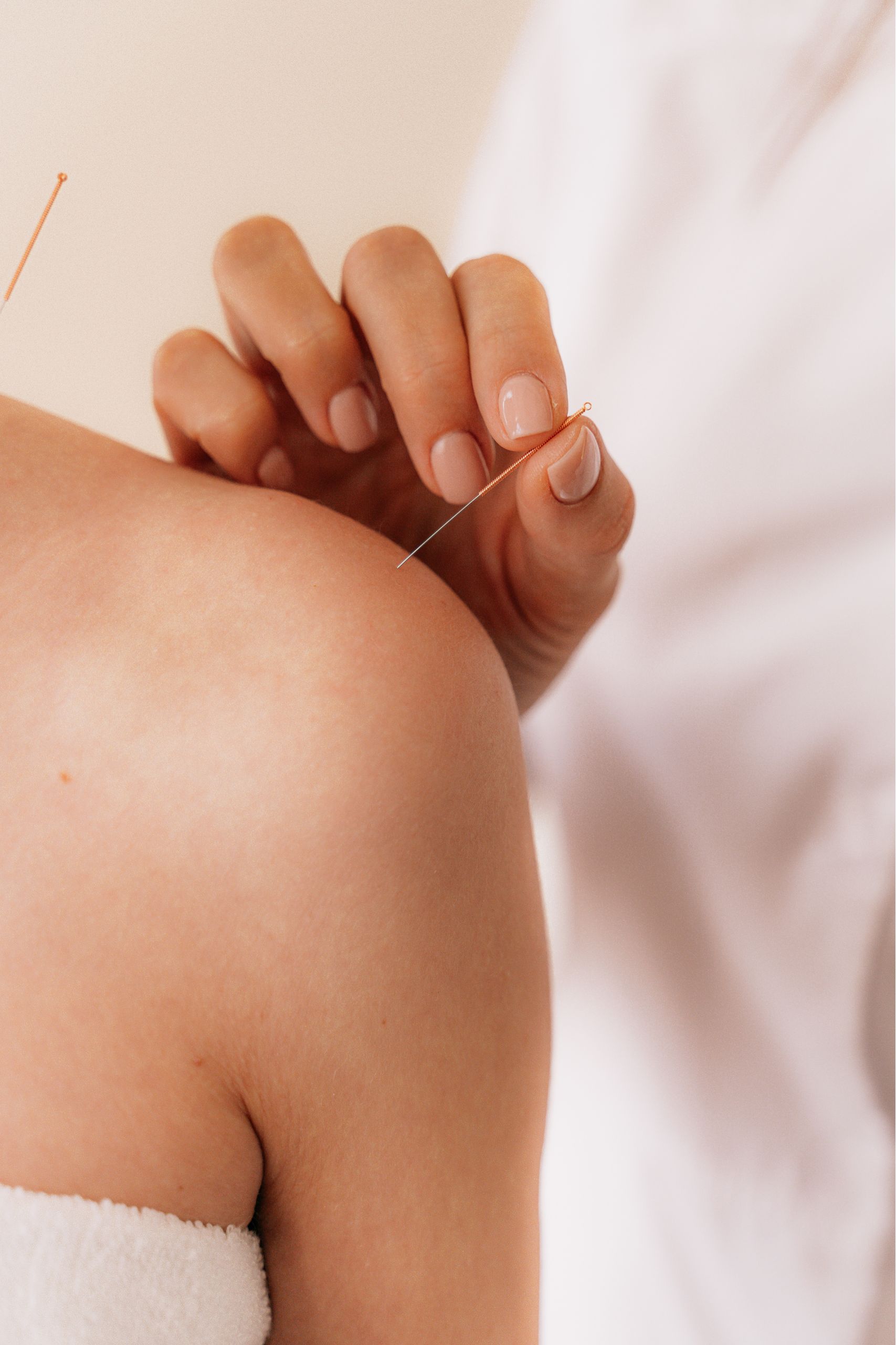 acupuncture 2